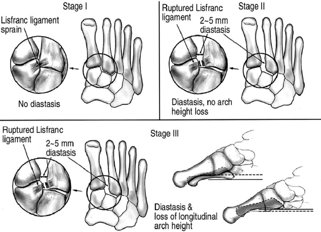 286 Hyun Seok Yim, et al. Fig. 3. Nunley classification of Lisfranc joint injuries. Data from the article of Nunley and Vertullo (Am J Sports Med 2002;30:871-878). 12) 4.