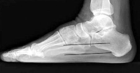 Lisfranc Joint Injuries: Diagnosis and Treatment 287 Fig. 5.