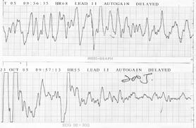 - 김철현외 6 인 : 돌연사로내원한남자선천성 QT 간격연장증후군 - Figure. Captured EKG monitoring when cardiopulmonary resurcitation was performed at admission. Figure 2.