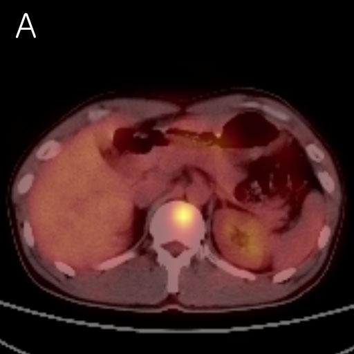 - 대한내과학회지 : 제 71 권제 6 호통권제 556 호 2006 - Figure 1. A 43-year-old man with non-small cell lung cancer. (A) PET-CT shows an area uptake in T12 (Arrow).