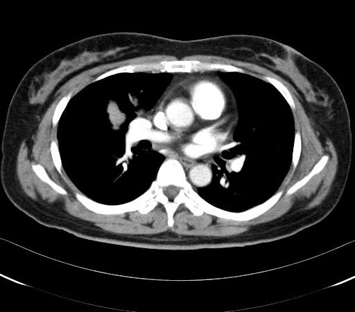 - 기성호외 7 인 : 폐암병기결정에서 PET-CT 의역할 - A B Figure 2.