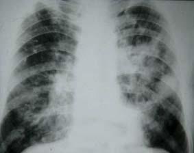 Tuberculosis and Respiratory Diseases Vol. 58. No. 6, Jun. 2005 Figure 7. Scar cancer in a 71-year-old man.