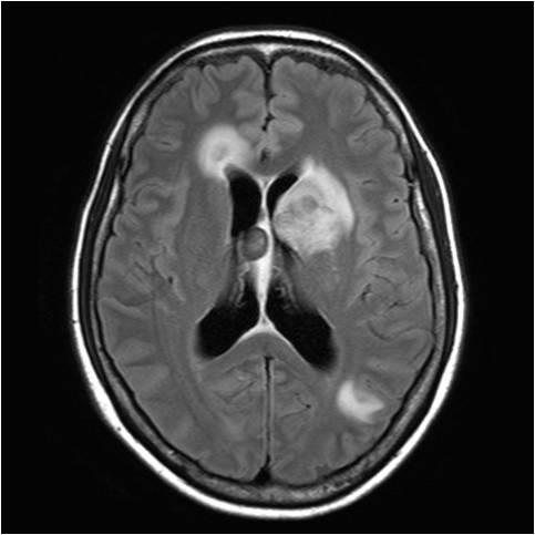 B) of the left basal ganglia, left thalamus, midbrain, and corticomedullary junction of both cerebral hemispheres. These findings are highly suggestive of lymphoma metastasis.