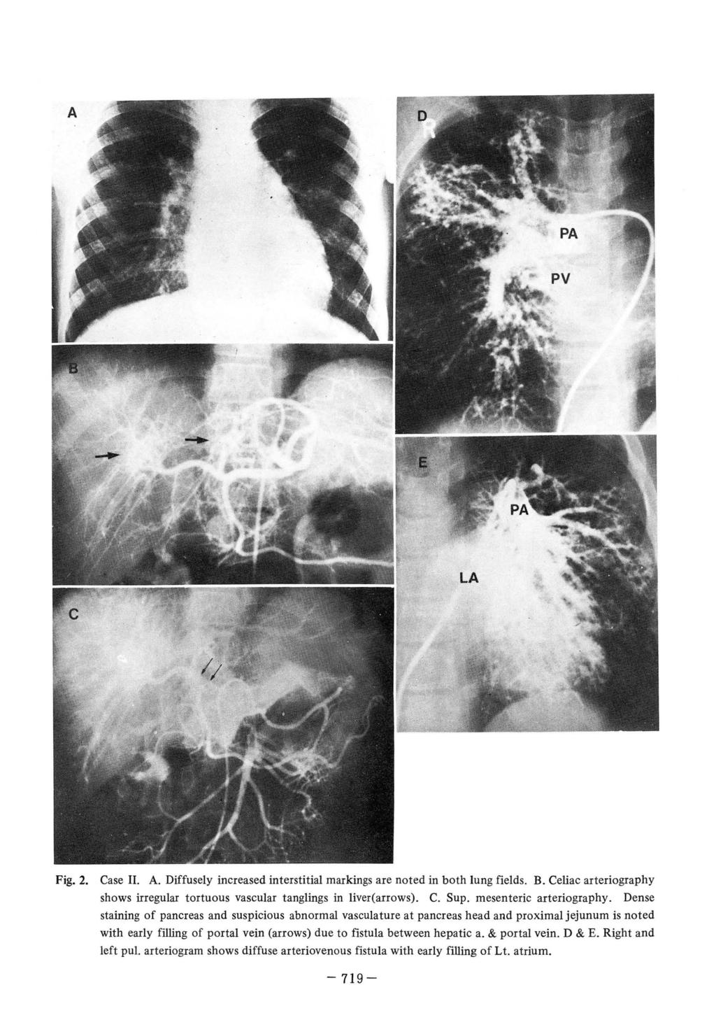 Fig. 2. Case II. A. Diffusely increased interstitial markings are noted in both lung fields. B. Celiac arteriography shows irregular tortuous vascular tanglings in liver(arrows). C. Sup.