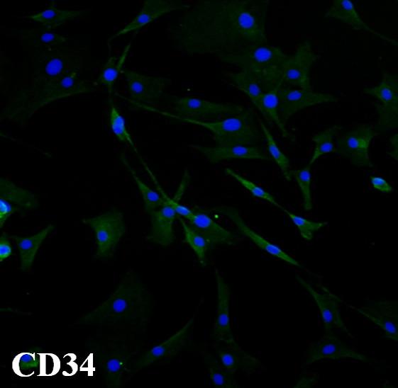 anti-cd34 (B), indeterminate staining with anti-desmin (C) and negative staining with anti-cd45 (D) with immunohistochemical staining