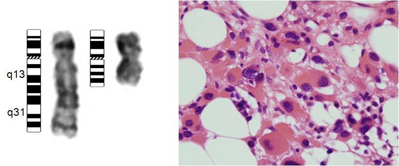 - 김명신. MDS 의염색체이상과임상적의의 - Figure 2. Partial karyogram (left) and morphology (right) in a bone marrow specimen from a patient with del (5q).