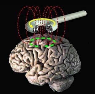 뇌를자극하는방법 TMS (Transcranial Magnetic Stimulation 경두개자기자극 )