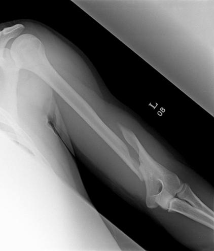188 권대규, 문경호, 나석인, 신병기, 이동주 Fig. 3. A 21-year-old man sustained the fracture in an accident. (A) An initial radiograph shows a spiral fracture of the distal humerus.