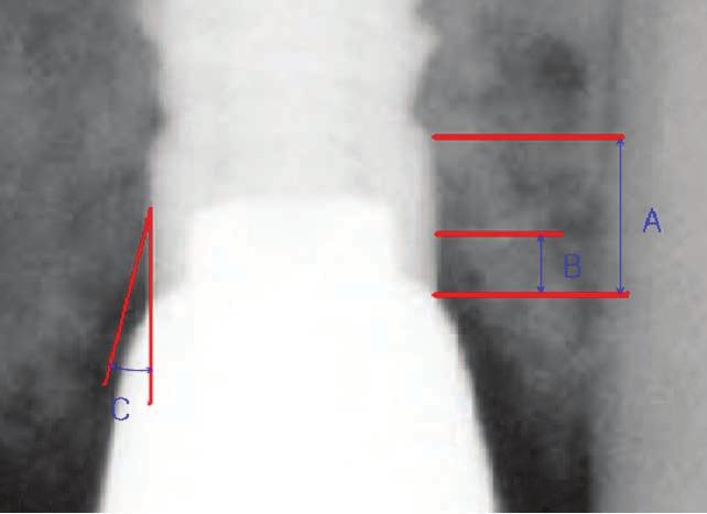 A; measurement of fixture collar B; measurement of the distance between fixture top and first bone-implant contact C; measurement of resorption angle Fig. 3.