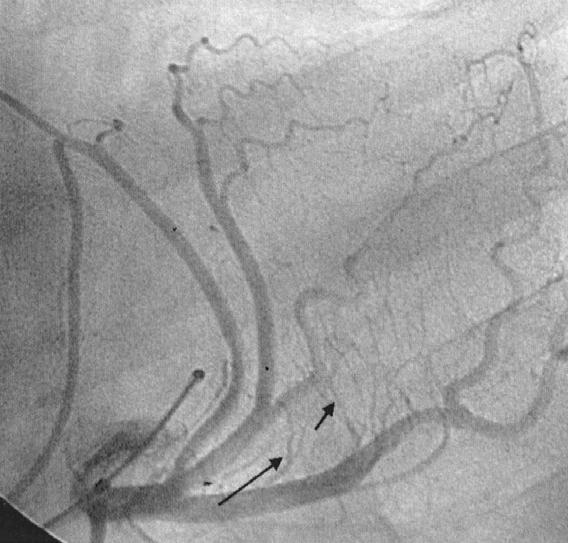 injection of contrast medium to define the perfusion area and to exclude reflux into the left anterior ascending coronary