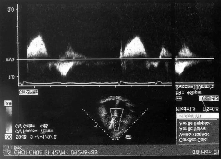 Echocardiographic changes before and after percutaneous transluminal septal myocardial