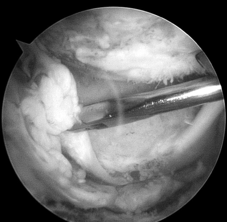 394 Sang Jin Cheon, et al. 관절낭염을보이는 1예의환자에서는관절낭유리술을시행하였다. 2. 수술방법모든수술은동일시술자에의해이루어졌으며전신마취하에측와위 (lateral decubitus position) 로시행하였다.