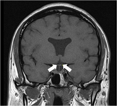 Brain magnetic resonance imaging (MRI) findings at presentation (A) Absence of septum pellucidum (arrow).