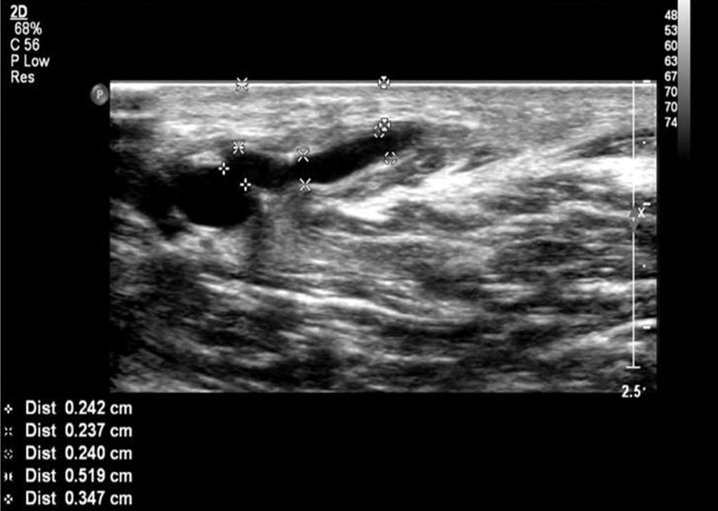 김정은외 A B Fig. 1. An 80-year-old male with immature radiocephalic arteriovenous fistula. A. The gray-scale of doppler ultrasonography shows a diameter of anastomosis, a serial caliber difference of proximal venous limb and depth of fistula.