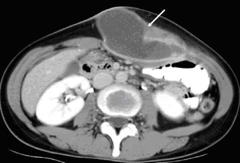 (B) Sixty-nine days earlier, the patient hada diagnosis of tuberculous peritonitis by CT and a biopsy, and antituberculosis therapy was started. A B Figure 2.