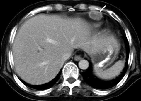 (A) Contrastenhanced CT shows two ovoid abscesses with a peripheral-enhancing wall and a central cystic lesion in the right and left perihepatic spaces.