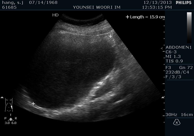 - Seong Sook Hong. Radiologic findings of pancreatic cystic neoplasms - D Figure 2. Mucinous cystic neoplasm of pancreas with invasive adenocarcinoma.