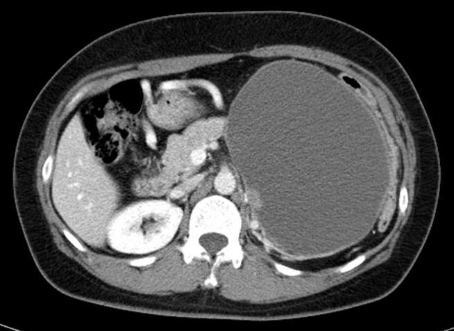Enhanced T () presents a large cystic mass in pancreatic tail portion within an enhanced papillary mural nodule.