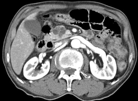 - 대한내과학회지 : 제 87 권제 3 호통권제 649 호 2014 - D Figure 3. Serous oligocystic adenoma of pancreas.