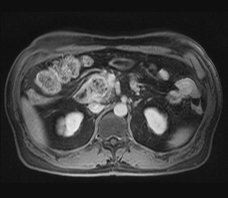 pancreatic duct of head portion due to tumor invasion.