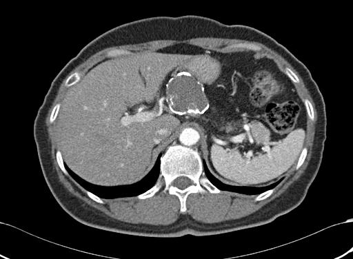 ontrast enhanced T shows a large cystic mass that has dense curvilinear calcification in the peripheral wall. These findings are suggestive of calcified pseudocyst.