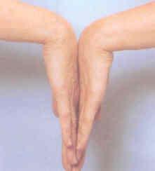 Carpal Tunnel Syndrome ( 수근관증후군 ) 손의통증과 numbness ( 특히밤에 ) -