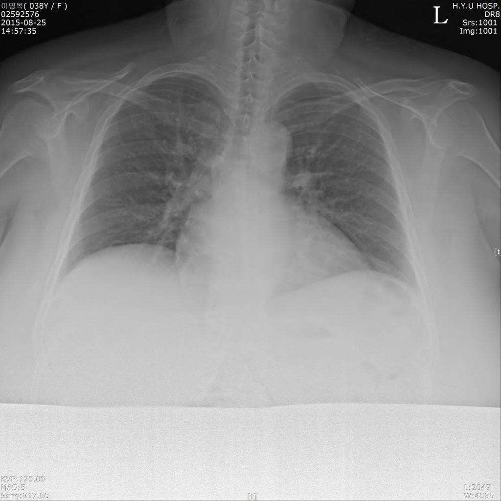 경희의학제 31 권제 1 호 2016 Fig. 1. This picture is the chest PA image on admission. It shows borderline cardiomegaly at gestational age 39 weeks.