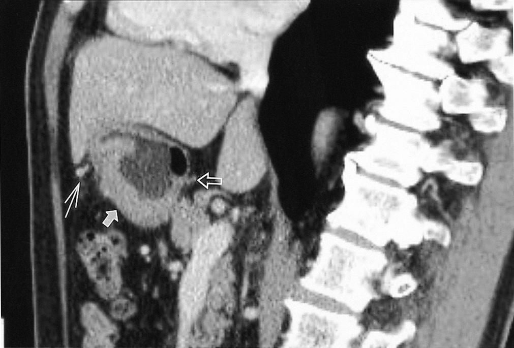 Fig. 6. 2D MPR in the sagittal orientation shows an irregular mass (solid arrow) in the anteroinferior portion of the gastric antrum.