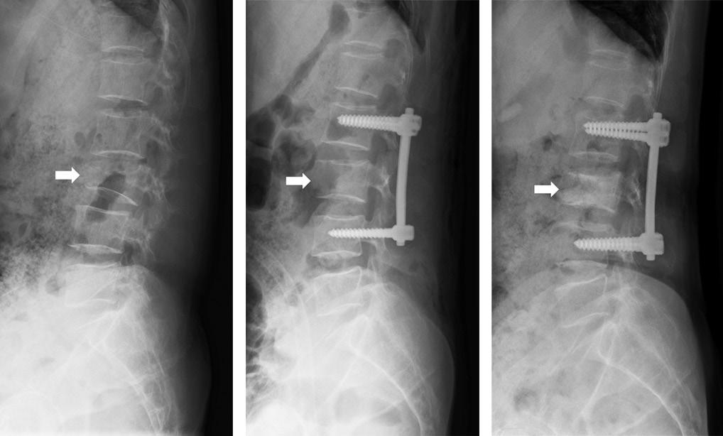 Journal of Korean Society of Spine Surgery Postoperative Loss of Reduction for Thoracolumbar Fractures 는요인에대해서는논란이있다. 이에, 저자들은흉-요추부불안정성골절에서후방수술을시행받고 1년이상추시된환자들을후향적으로분석하여, 수술후정복소실에영향을미치는요인들을분석해보고자하였다.