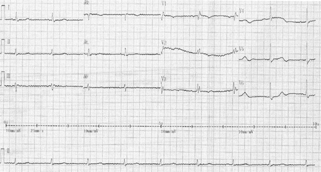 After partial correction of serum sodium to 125 meq/l, the ECG changed to sinus bradycardia at 42 bpm with a complete right bundle