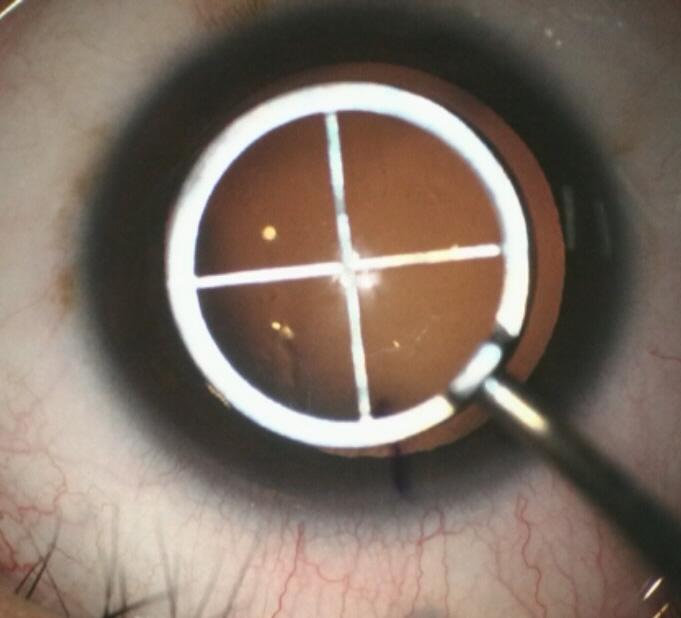 (A) Corneal marking at the steepest axis with marking pen using CALLISTO eye system