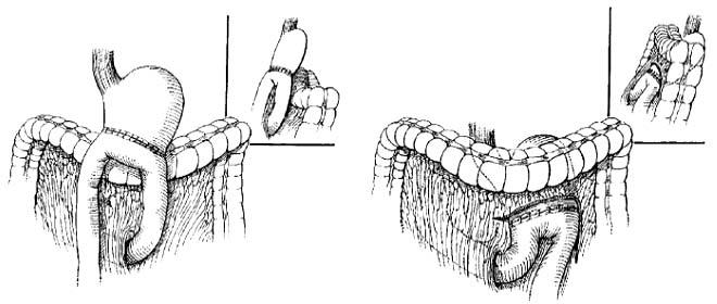 3 1) 위절제술및위십이지장문합술 (Billroth I)(Fig. 1): 위는절제범위에따라위장의축소정도가다양하며위내로담즙의역류가관찰된다. 위십이지장문합부는대개대만부쪽에서발견되는데위의봉합부위를나타내는저명한위점막주름이종종소만부를따라관찰 Figure 2. Drawings showing types of Billroth II reconstructions.