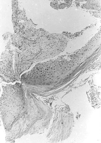 후두백반증 Fig. 6. Squamous cell carcinoma. Mucosal surface reveals thickened layer of atypical squamous cells with focal irregular invasion to lamina propria H & E, 40. Fig. 5.