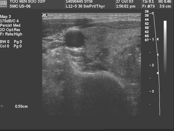 - 이은영외 10인 : 임신중상기도폐쇄로발견된기관내이소성갑상선 1예 - A B Fig. 3. Thyroid sonography shows a 0.6 cm-sized low echoic nodule with internal calcification, and 0.