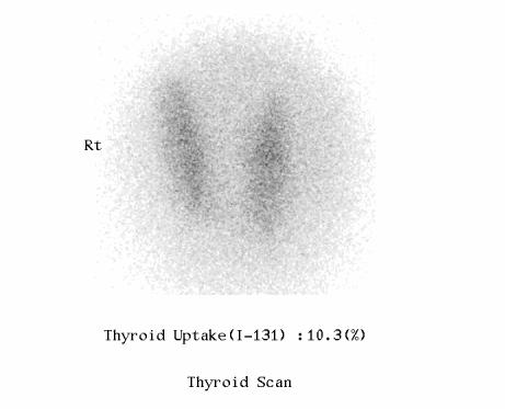 I 131 thyroid scan shows mildly enlarged thyroid gland with heterogeneous radioiodine uptake (10.3%). The scan do not show any lesion of abnormal radioiodine uptake.