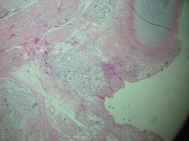 The microscopic finding shows that the mass shows thyroid follicles with nodular hyperplasia. Note the thyroid cartilage adjacent to the thyroid follicles. (H&E, 100) Table 1.