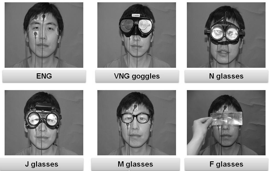 정성도외 3 인. 프렌첼안경에따른시고정억제능력의차이 검안경, 종이눈가림법등다양한방법이사용될수있다. 이중프렌첼안경과비디오안진검사 (videonystagmography, VNG) 가임상에서가장보편적으로사용되고있다. 프렌첼안경의볼록렌즈는시고정을억제하는역할을할뿐만아니라, 동공을확대시켜보여주므로안진의관찰을더욱용이하게한다.