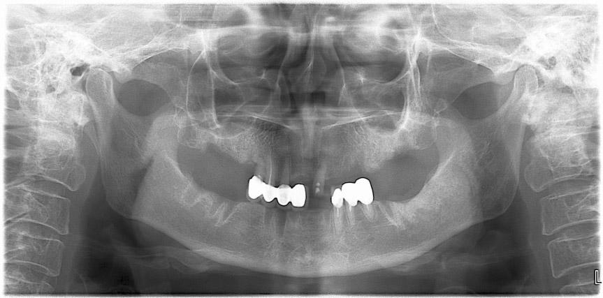 J Korean Assoc Oral Maxillofac Surg 2011;37:1-8 Fig. 2. The lamina dura remains after extraction. Fig. 3.