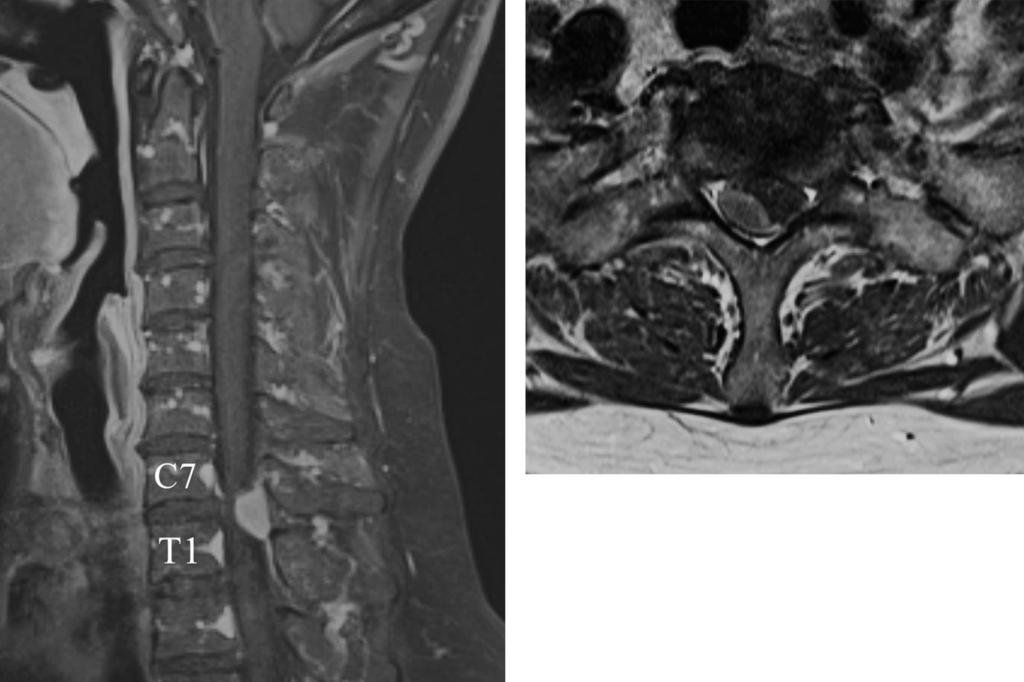 Journal of Korean Society of Spine Surgery Laminoplasty and Recapping Procedure Fig. 1. Gadolinium-enhanced magnetic resonance images show an intradural extramedullary tumor at C7-T1 level. Fig. 2.