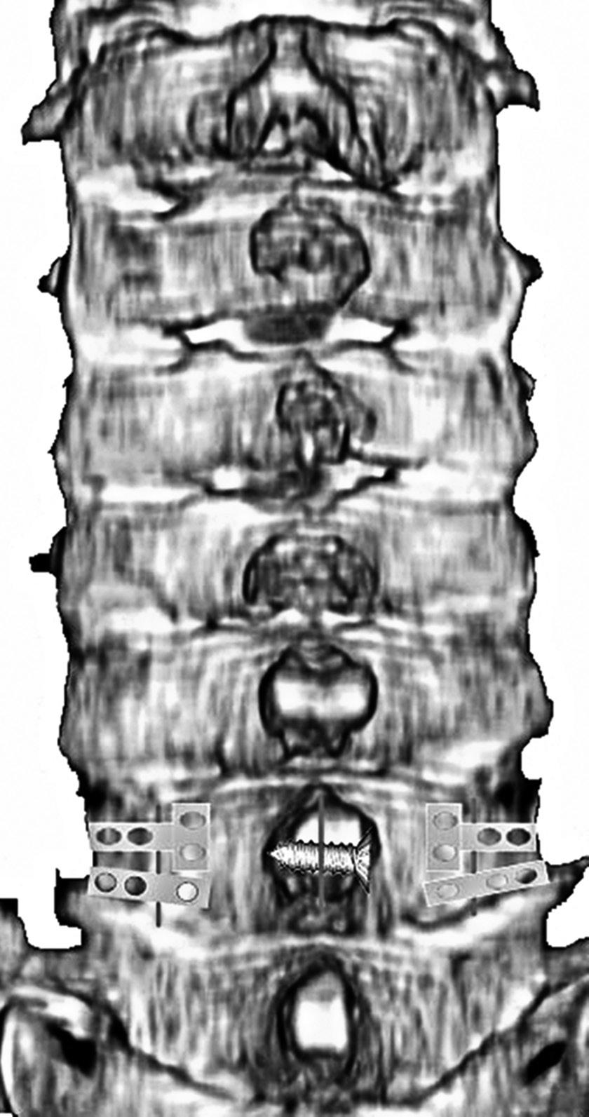 , Utsunomiya, Japan) 을이용하여제 7경추를정중앙에서종으로절단한뒤 (Fig. 3A), 좌측과우측모두후궁의외측과외측괴 (lateral mass) 의경계부위에 3 mm 고속연마기 (high speed burr) 를이용하여근위부피질골만갈아내어경첩 (hinge) 을만드는 Kurokawa 후궁성형술을시행하였다.