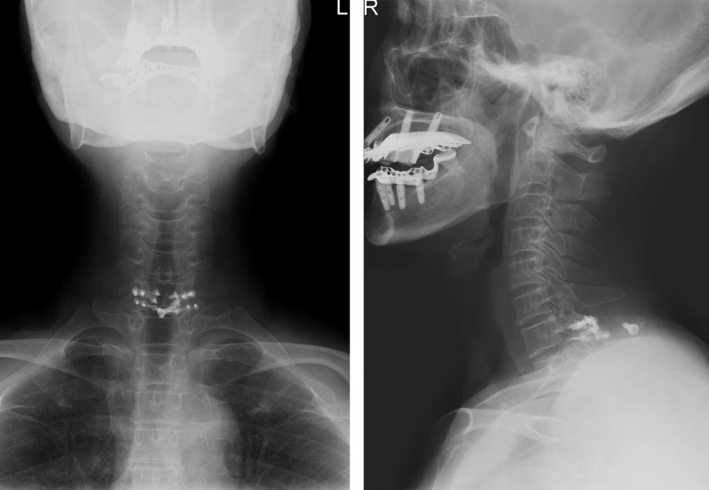 Journal of Korean Society of Spine Surgery Laminoplasty and Recapping Procedure Fig. 5. A plain X-ray taken after 2 years after surgery shows good alignment without any metal failure.