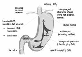 역류성식도염의진단및치료 / 박영규 Associated conditions Age: intensity of Sx after age of 50yrs (frequency of Sx: no change) Sex M: more erosive esophagitis, Barret s,