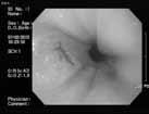 9%) M/55, Acid regurgitation X X X X 4) 1cm 간격 4 방향 (15.2%) 5) 2cm 간격 4 방향 (15.