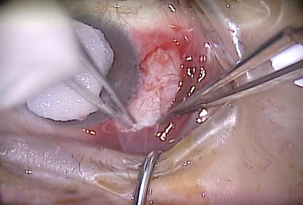 Surgical steps of triple-procedure in