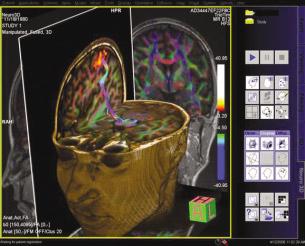 뇌암의 수술여부와 수술 후 정상활동 여부을 판단할 수 있는 중요한 검사 기법이다. 그리고 신경세포들을 DTI 기법을 이용하여 표현할 수 있는 검사방법도 이용되고 있다.