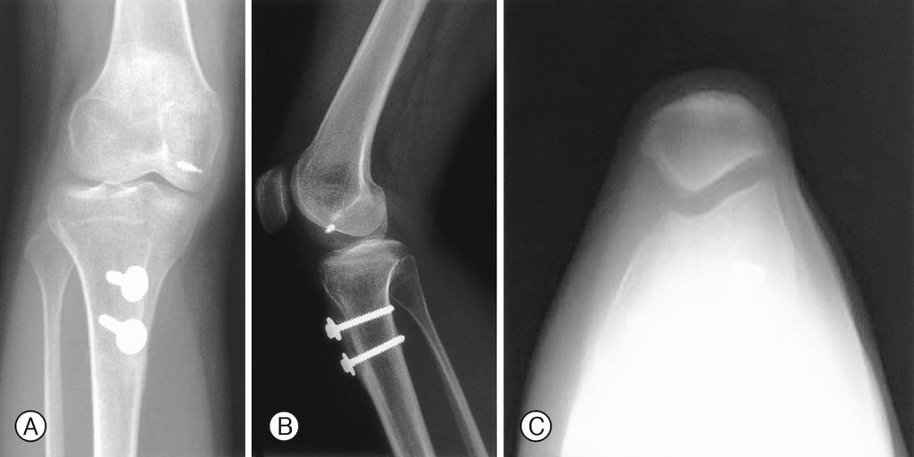김덕원ㆍ안종호ㆍ이 강ㆍ이은군ㆍ김진구 Fig. 2. A, B, C. Postoperative anteroposterior (A), lateral (B) and Merchant (C) radiographs of knee.