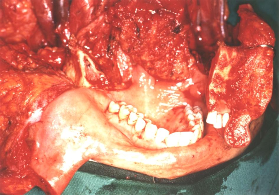 진행된 구강암의 광범위 절제 후 이중 유리피판을 이용한 재건술 2예 Fig. 1. Case 1.