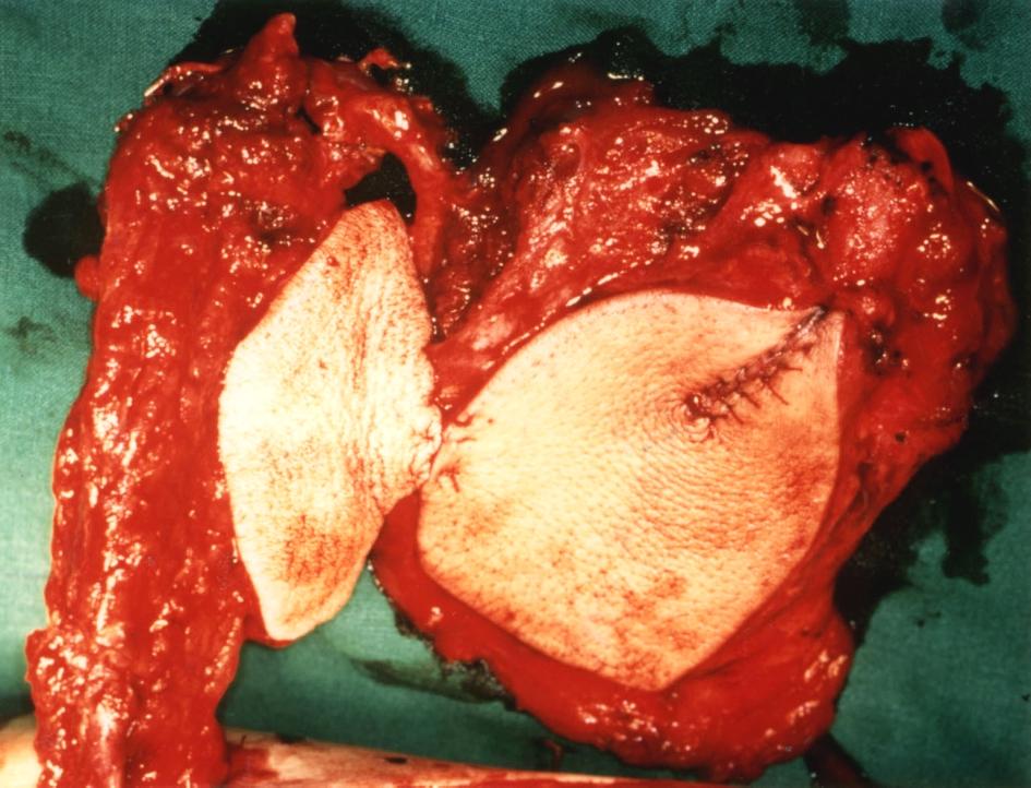 Note the anastomosis of vessels (arrow). Fig. 5. Case 2.