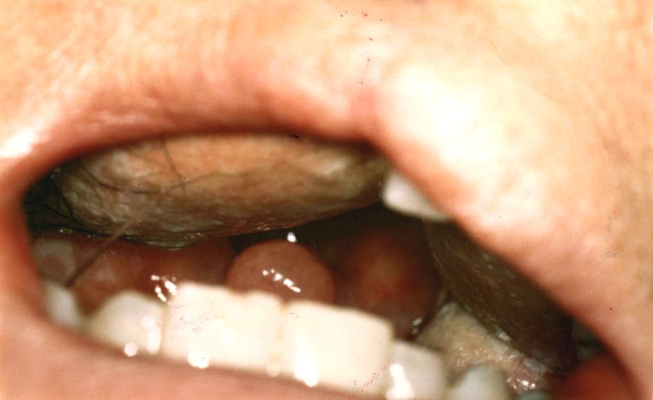 술 후 환자는 턱밑에 창상감염으로 인해 구강 섭취가 늦어 Fig. 6. Case 2.