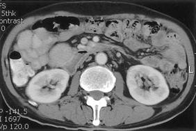 -Hong Seok Song, et al : A case report of Zollinger-Ellison syndrome - A B Figure 2. (A & B) Abdomen CT scan. A 5 x 4.5 cm sized, well defined solid mass at the head of the pancreas.